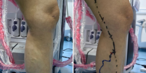 突破!永济市医疗集团人民医院成功开展下肢静脉曲张