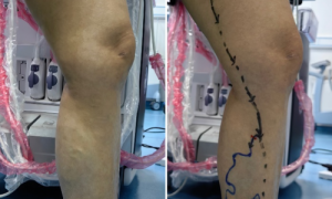 突破!永济市医疗集团人民医院成功开展下肢静脉曲张